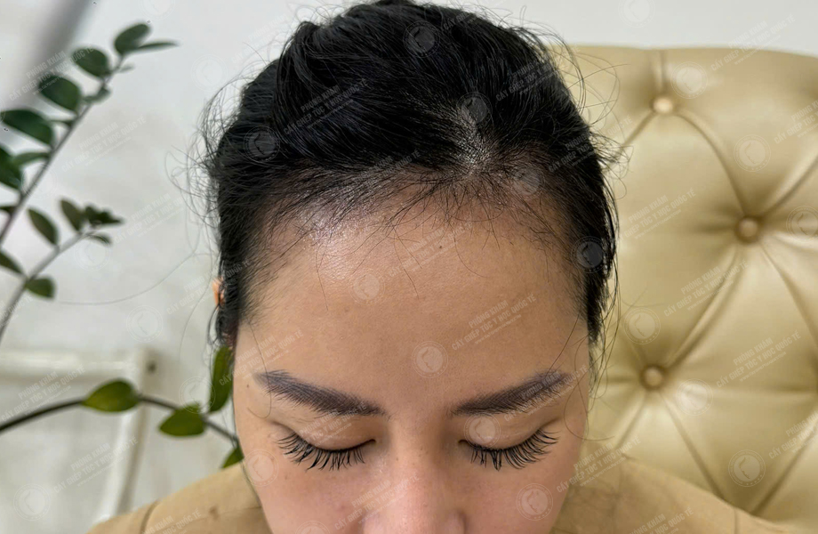 Lê Lan Anh - Cấy tóc đường chữ M 10