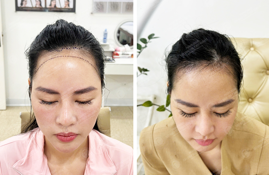  Lê Lan Anh - Cấy tóc tự thân 1