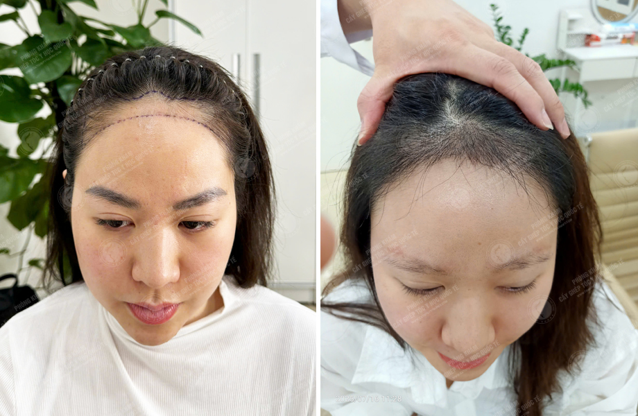  Trần Hồng Nhung - Cấy tóc đường chữ M 1
