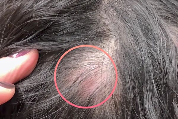 Minoxidil có làm thâm da đầu không? Hiểu đúng để tránh tổn thương da đầu lâu dài
