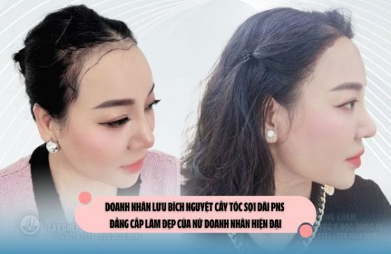 Doanh nhân Lưu Bích Nguyệt cấy tóc sợi dài PNS – Đẳng cấp làm đẹp của nữ doanh nhân hiện đại