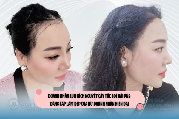Doanh nhân Lưu Bích Nguyệt cấy tóc sợi dài PNS – Đẳng cấp làm đẹp của nữ doanh nhân hiện đại