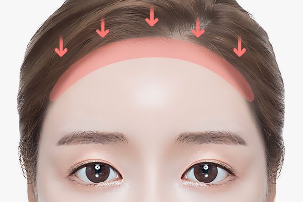 Hạ đường chân tóc có đau không? Sự thật ai cũng nên biết trước khi làm