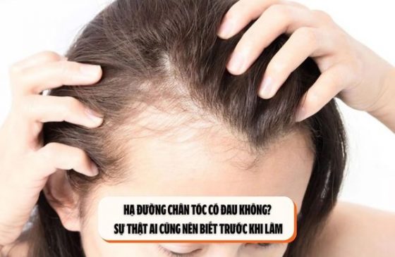 Hạ đường chân tóc có đau không? Sự thật ai cũng nên biết trước khi làm