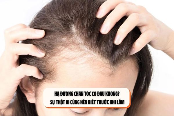 Hạ đường chân tóc có đau không? Sự thật ai cũng nên biết trước khi làm