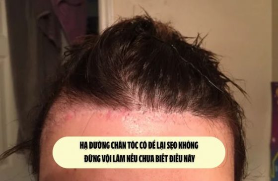 Hạ đường chân tóc có để lại sẹo không – Đừng vội làm nếu chưa biết điều này