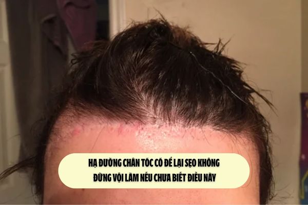Hạ đường chân tóc có để lại sẹo không – Đừng vội làm nếu chưa biết điều này