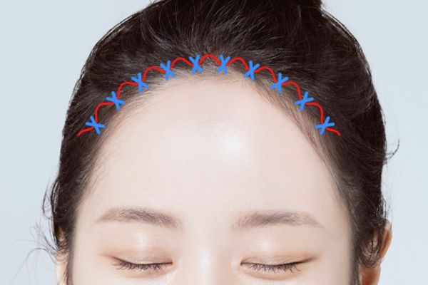 Hạ đường chân tóc có để lại sẹo không – Đừng vội làm nếu chưa biết điều này