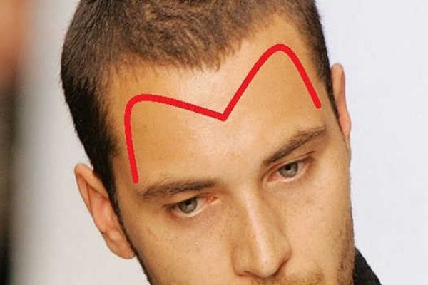 Ca sĩ Phạm Trưởng cấy tóc hói chữ M – Thực trạng hói chữ M ở nam giới và giải pháp hiệu quả