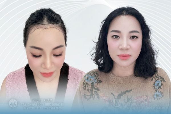 Doanh nhân Lưu Bích Nguyệt cấy tóc sợi dài PNS – Đẳng cấp làm đẹp của nữ doanh nhân hiện đại