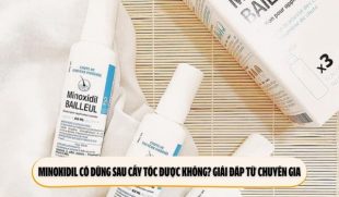 Minoxidil có dùng sau cấy tóc được không? Giải đáp từ chuyên gia