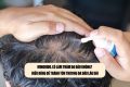 Minoxidil có làm thâm da đầu không? Hiểu đúng để tránh tổn thương da đầu lâu dài