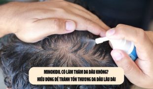 Minoxidil có làm thâm da đầu không? Hiểu đúng để tránh tổn thương da đầu lâu dài