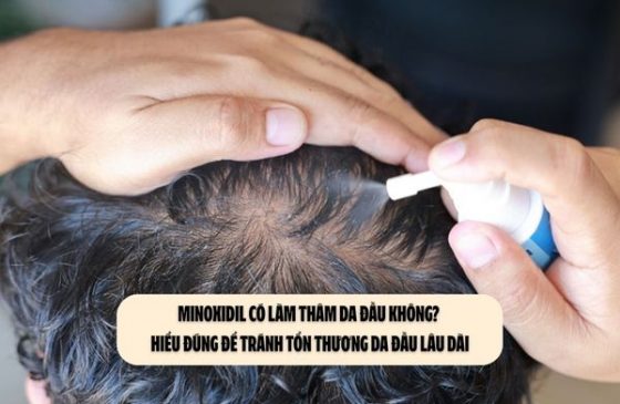 Minoxidil có làm thâm da đầu không? Hiểu đúng để tránh tổn thương da đầu lâu dài