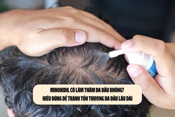 Minoxidil có làm thâm da đầu không? Hiểu đúng để tránh tổn thương da đầu lâu dài