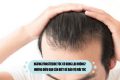 Ngưng Finasteride tóc có rụng lại không? Những điều bạn cần biết để bảo vệ mái tóc