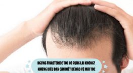 Ngưng Finasteride tóc có rụng lại không? Những điều bạn cần biết để bảo vệ mái tóc