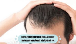 Ngưng Finasteride tóc có rụng lại không? Những điều bạn cần biết để bảo vệ mái tóc