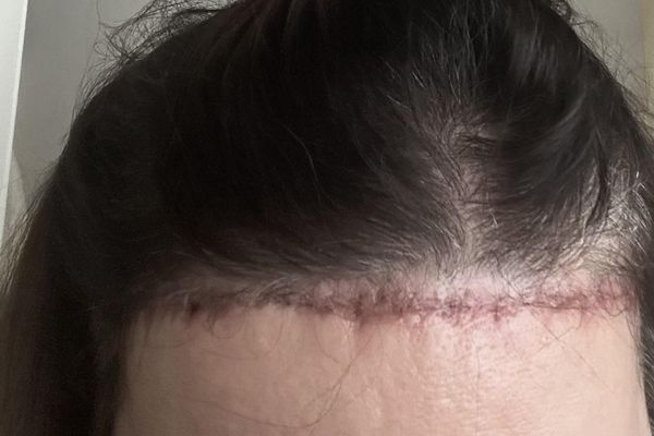 Hạ đường chân tóc có để lại sẹo không – Đừng vội làm nếu chưa biết điều này