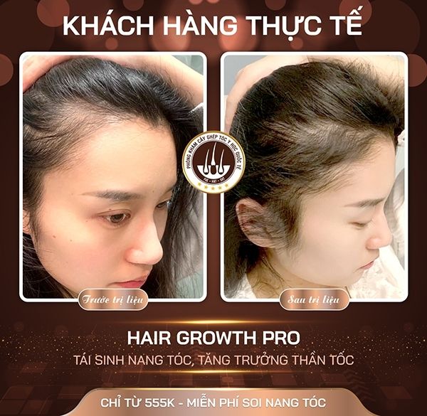 Đang mang thai có dùng Minoxidil được không? Những điều mẹ bầu cần biết để bảo vệ tóc