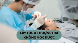 Cấy tóc tại Thượng Hải không mọc được – Những điều người cần cân nhắc trước khi “xuất ngoại” cấy tóc
