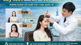 Cấy tóc ở đâu tốt tại Việt Nam? Địa chỉ được nhiều khách hàng lựa chọn hiện nay
