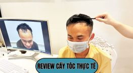 Review cấy tóc thực tế: Trải nghiệm của tôi sau 12 tháng và quyết định thay đổi ngoại hình