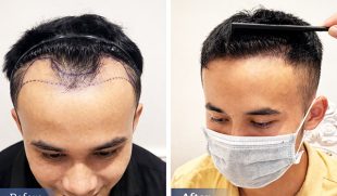 Trước và sau khi cấy tóc khác biệt thế nào? So sánh chi tiết từ A–Z