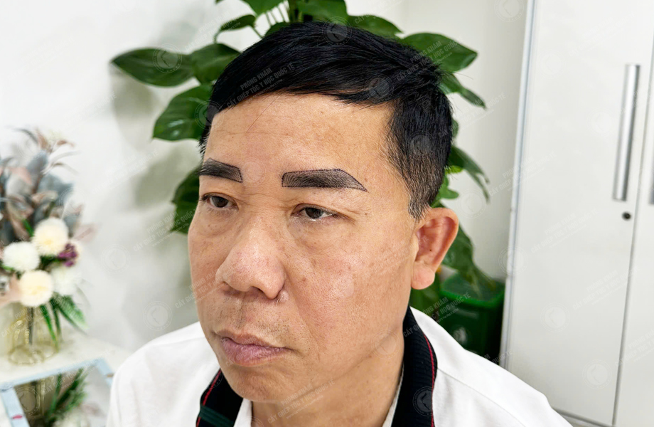 Trần Ngọc Sơn - Cấy lông mày 2