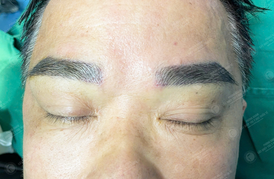 Trần Ngọc Sơn - Cấy lông mày 4