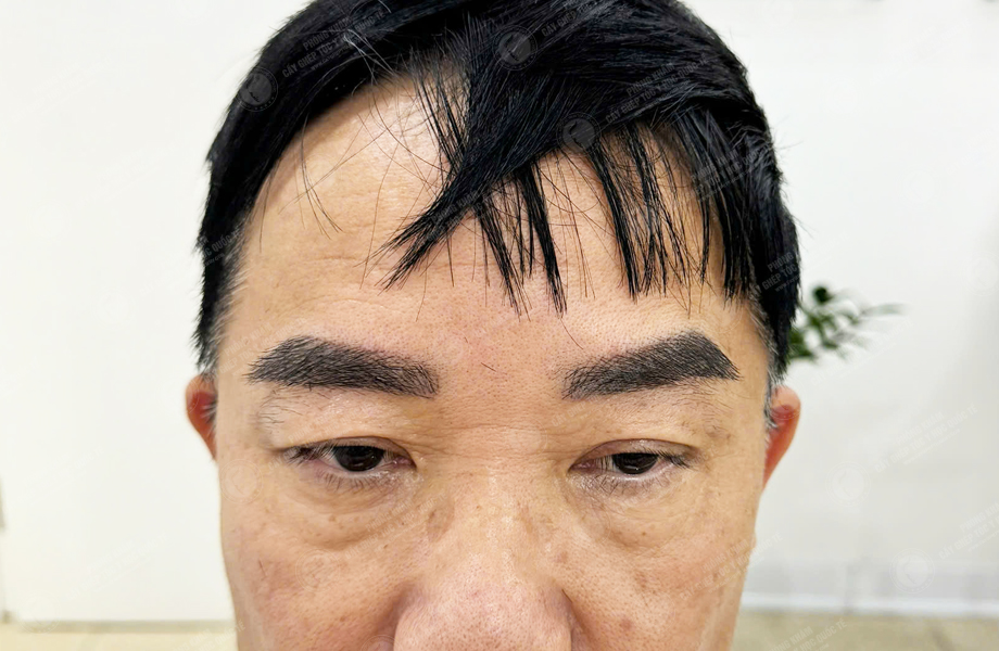 Trần Ngọc Sơn - Cấy lông mày 5