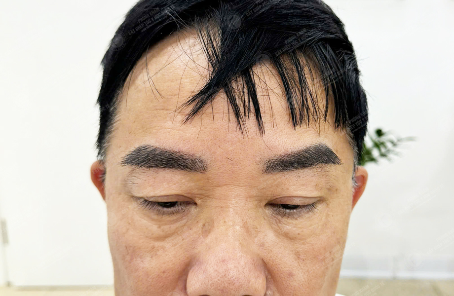 Trần Ngọc Sơn - Cấy lông mày 7