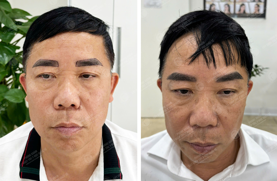  Trần Ngọc Sơn - Cấy lông mày 1