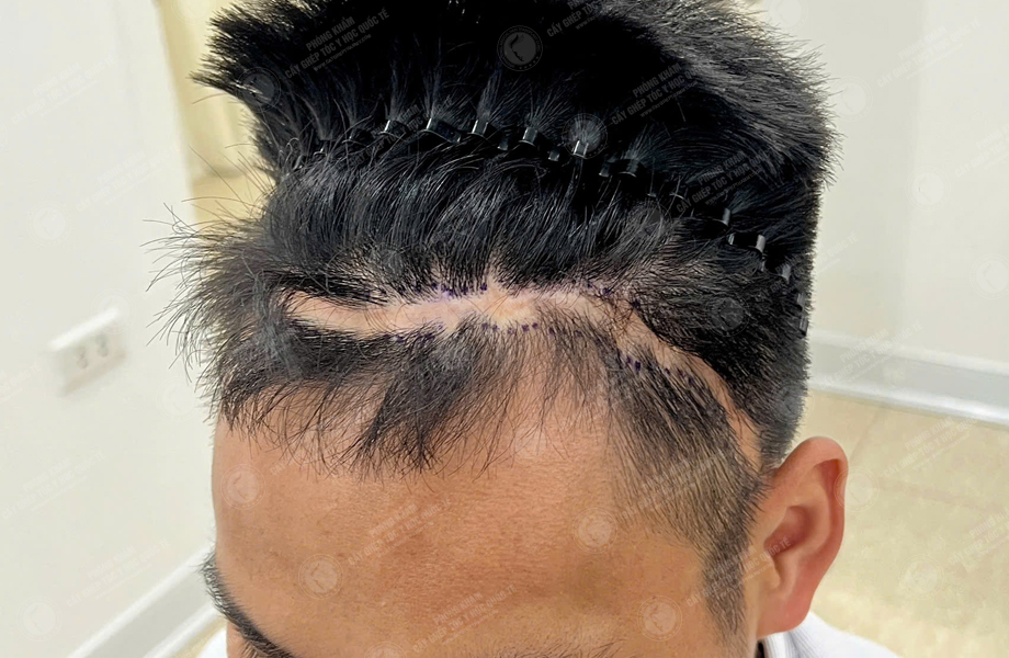 Hoàng Văn Tuấn - Cấy tóc trên sẹo 2