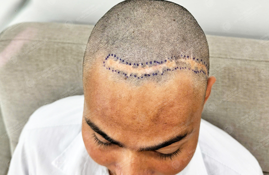 Hoàng Văn Tuấn - Cấy tóc trên sẹo 3