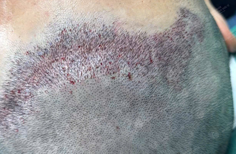 Hoàng Văn Tuấn - Cấy tóc trên sẹo 4