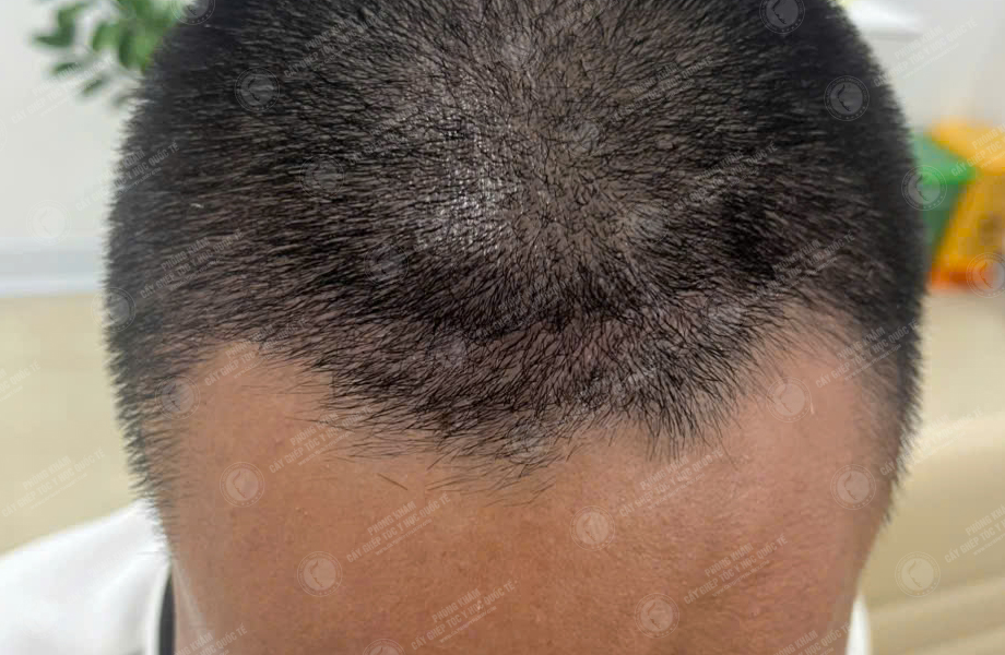 Hoàng Văn Tuấn - Cấy tóc trên sẹo 5