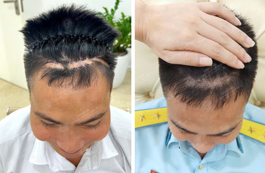  Hoàng Văn Tuấn - Cấy tóc trên sẹo 1