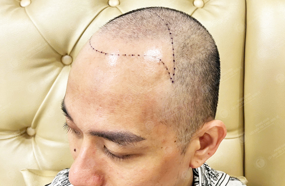 Lý Văn Thế - Cấy tóc đường chữ M 2