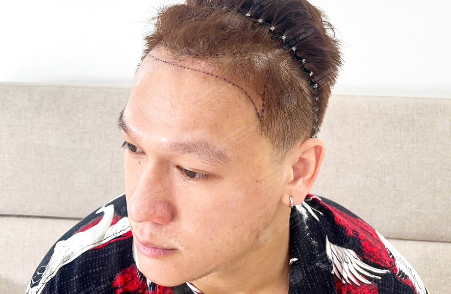 Đoàn Văn Sơn - Cấy lông mày 2