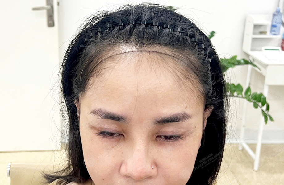 Lê Thị Hạnh - Cấy tóc đường chữ M 2