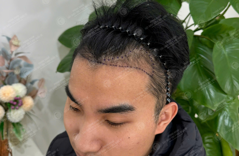Nguyễn Đức Hùng - Cấy tóc đường chữ M 2