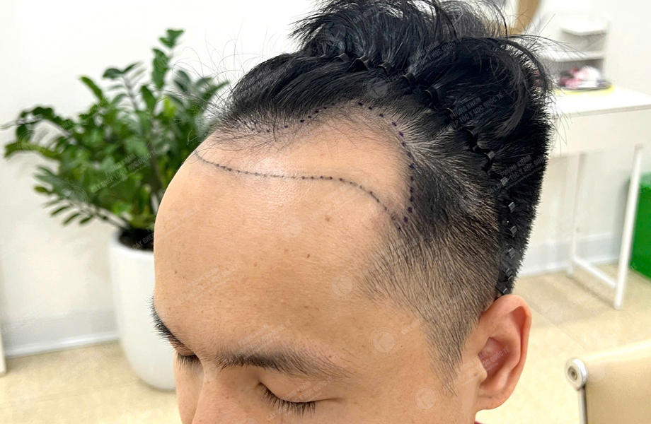 Phạm Quang Nhật - Cấy tóc đường chữ M 2