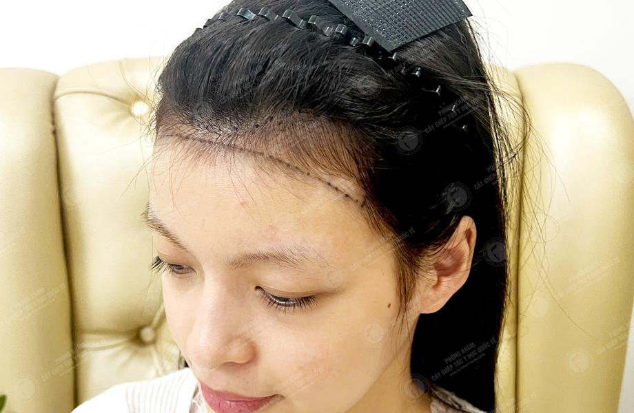 Nguyễn Thanh Tâm - Cấy tóc đường chữ M 2
