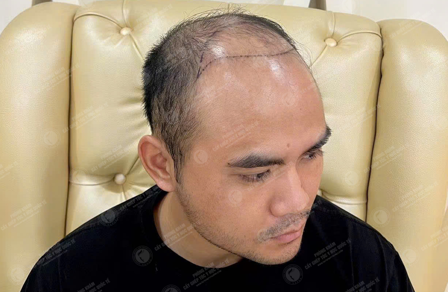 Ngô Văn Tâm - Cấy tóc đường chữ M 2