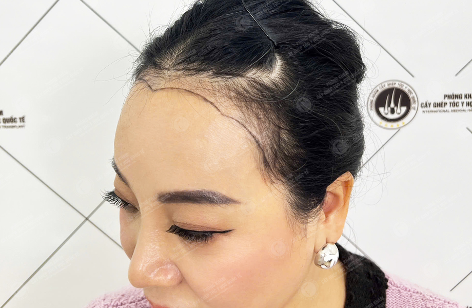 Lưu Bích Nguyệt - Cấy tóc đường chữ M 2