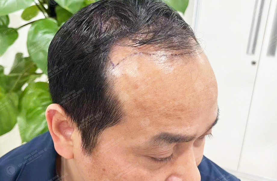 Trần Trung Anh - Cấy tóc đường chữ M 2