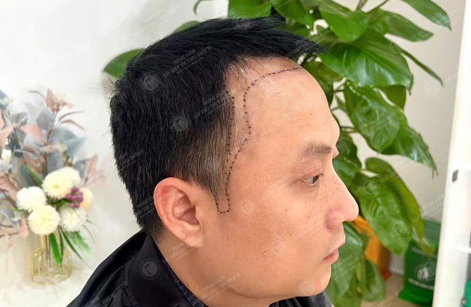 Trần Xuân Đông - Cấy tóc đường chữ M 2