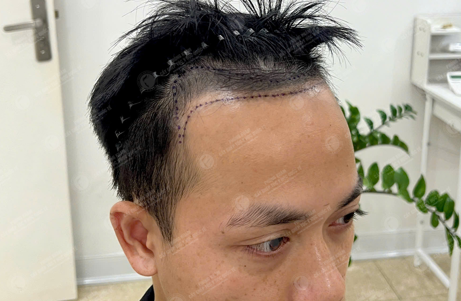 Nguyễn Huy Hùng - Cấy tóc đường chữ M 2