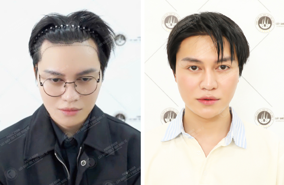  Cường Jin - Cấy tóc đường chữ M 1